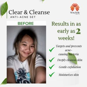 Mon Belle Clear & Cleanse Anti- Acne Set