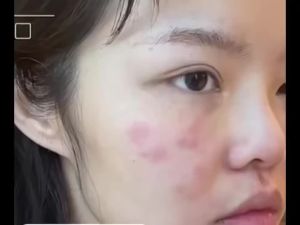 SADOER | Salicylic Acid Acne Treatment Face Cream Repair Pimple Spots Deep Cleaning Pore Anti-acne Scar Oil Control Moisturizer Skin Care