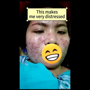 Acne Treatment Cream 50g/Obat jerawat dan bekas jerawat penghilang salep obat paling ampuh removal of acne cream untuk pria dan wanita menghilangkan dengan cepat