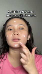 Skinoren Azelaic Acid 20% Cream Acne Removal Acne Treatment Marks Scar Oil Control Acne Pimples 30g