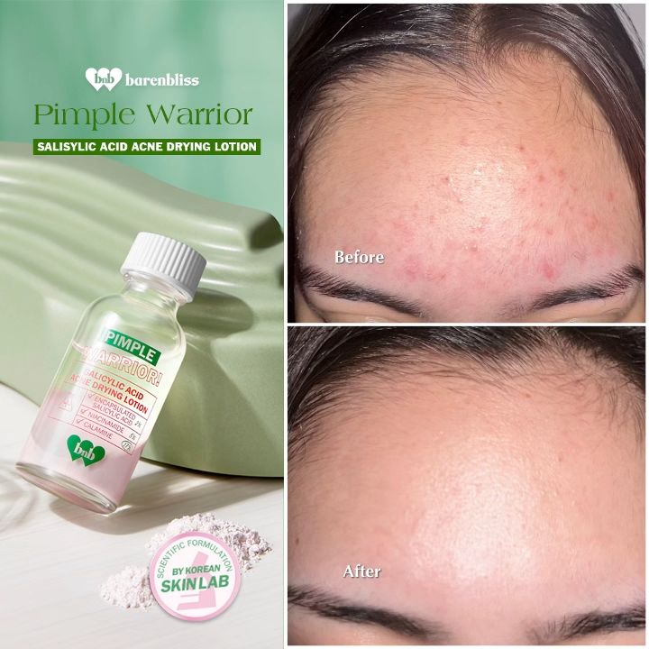 【BUY1 GIFT 1】 barenbliss BNB Pimple Warrior! Salicylic Acid Acne Drying Lotion - With Salicylic Acid & Niacinamide | Acne Spot Treatment Care | Acne Scars Clarifier | Inflammation & Redness Reliever