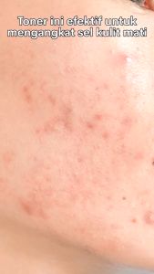 Tomato Mochi ~ SKINTIFIC Toner 5% AHA BHA PHA Exfoliating 80ml & Cleans Pores