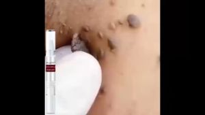 Wipeoff tags moles remover pen original permanent ointment kasoy wart removal stock solution painless and effective Natural non-irritating 100% effective traceless repair solution pen flesh mole artifact smooth the skin skin tag skin clearing pen authent