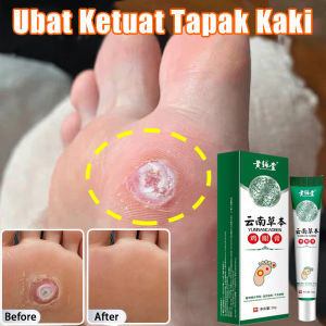 ubat ketuat tapak kaki 20g corn plaster Foot corn removal Hand corn kernels removal Ubat Ketuat Tapak Kaki corn 肉粒去除 鸡眼膏