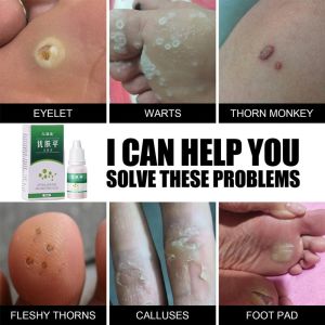 Obat Mata Ikan Remove wart antibacterial liquid Foot Corn Warts Liquid Deep Penetration Treatment Foot Calluses Ccorns Thorn Wart Remove Skin Tags 10ml with Cotton Swab Anti-itch and Painless Dual Repair Reduces Wart Regeneration inhibit fungal growth liq