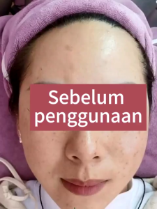 Krim Niacinamide Pencerah 20g krim pencerah dan penghilang noda cocok untuk penggunaan siang dan malam. Krim ini menyamarkan noda hitam memiliki sifat anti-penuaan dan anti-kerut serta membantu menyamarkan bekas jerawat. BPOM