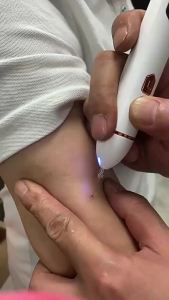 Bút Laser Plasma 9 Cấp Độ Loại Bỏ Đốm Đen Trên Da Mặt