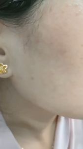 Sản phẩm sỉ dùng Spa làm tiêu còi mụn xóa nốt ruồi cải thiện sẹo rỗ