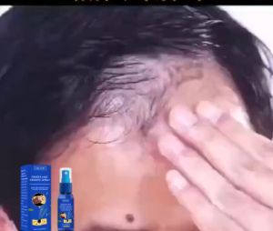 EELHOE Spray Penumbuh Rambut Cepat - Obat Kebotakan Pria BPOM Anti Rontok Parah & Regenerasi Folikel