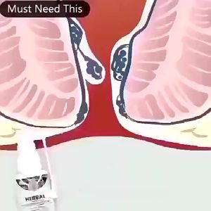 Hemorrhoids Spray Natural Herbal Stop Bleeding Reduce Pain Relieve Swelling Fissure Bloody Stool inflammation Treatment 天然草药舒缓肿胀痔消肉球痔疮喷雾内外肛舒喷剂