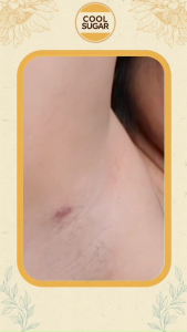 Encapsulated Body Acne Spray Coolsugar Bocne - Jerawat Punggung dan Area Sensitif + Paket Hemat