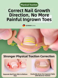 CMGF | Ingrown Nail Correction Tool Ingrown Toenail Correction Patches