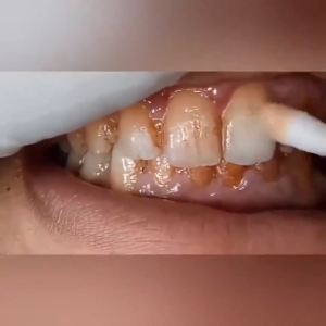 EELHOE Teeth Whitening Essence Powder Oral Hygiene Cleaning Serum Removes Plaque / Pemutih Gigi Kuning dan Karang Permanen / Pembersih Perontok Karang Gigi dan Bau Mulut / Dazzling White Pen