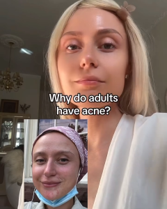 AMEON 🇺🇸 BABY BUDDHA – Calming Serum 1oz/30m 🕊️l  A soothing serum specially formulated to calm adult acne. Helps reduce visible redness patchiness irritation and signs of aging.🍃Biomedical SkinCare that heals