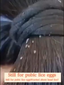 Head Lice Removal Shampoo: Effective Solutions for Kids & Adults