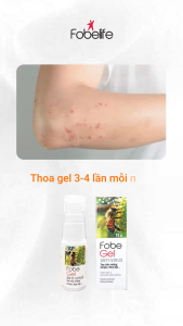 Kem Bôi FobeGel Nano Bạc Keo Ong Xanh – Làm Dịu Da Tay Chân Miệng Zona Thủy Đậu Kiến Ba Khoang