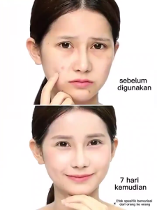 Combination Skincare Set Salicylic Acid 15% Rendi Acid Oil Control Anti aging Rejuvenating Lubricate Pore Refining