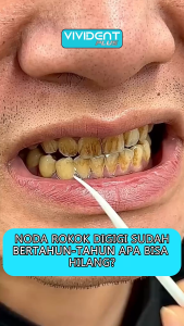 VIVIDENT Mouthwash Obat Kumur Antibakteri Pembersih Mulut Bau Hilang Nafas Wangi Tahan Lama BPOM