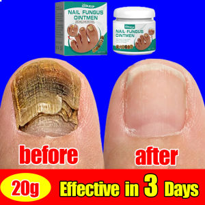 【Effective in 3 days】South Moon Nail fungus repair cream 20g Effective Fungus Removal ParonychiaOnychomycosisAthletes foot (Nail care ointment Fungal nail treatment ointment nail treatment fungal ointment gamot sa nasisirang kuko)