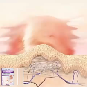 ORI 100% Silicone Scar Sheets Plester Silikon Penghilang Keloid Bekas Luka Scar Operasi Strech Mark