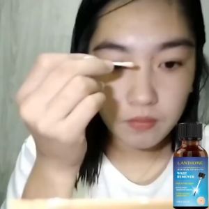 Warts Remover Kasoy Oil: A Comprehensive Guide