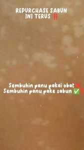 Mouluss - BPOM 3x Efektif Mengatasi Panu Jerawat Tubuh & Muka Sabun Panu