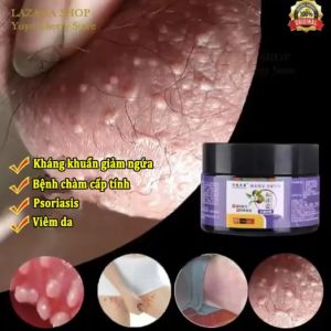 Kem bôi nấm riêng tư cải thiện tình trạng vảy nến á sừng