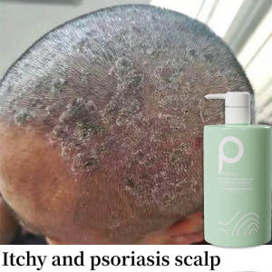 Anti dandruff shampoo oil control sea salt Shampoo     syampoo kelemumur syampu  洗发水Deep clean scalp reduce dandruff hair treatment removes mites Scalp Care scalp psoriasis Relieve itchy scalp Bald