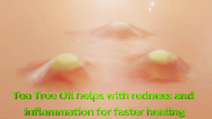 Pure Organic Anti Acne Cream With Salicylic Acid Sulfur Tea Tree Oil and Witch Hazel Extract