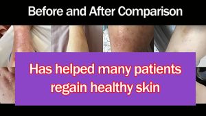 Itchy Hands Itchy Skin Itchy Skin Allergy Mosquito Bites Antiseptic Natural Herbal Zinfandel Antibacterial Antipruritic Cream 30g