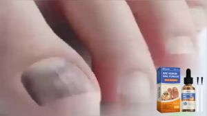 50ml Dung Dịch Chăm Sóc Nấm Móng Tay Chống Nhiễm Trùng Sửa Chữa Bệnh Nấm Móng Tay Cho Móng Tay Bị Nứt Nẻ - Tinh Chất Chăm Sóc Sức Khỏe Móng Tay
