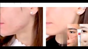 Whitening Freckle Cream Remove Dark Spot Cream Perawatan Kulit Pemutih Efektif Menghilangkan Melasma Jerawat Bintik Hitam Pigmentasi