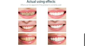 LANBENA Teeth Whitening Mousse: Membersihkan Noda Gigi & Perawatan Gigi Sehat