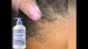 selenium sulfide shampoo Original anti dandruff shampoo 300ml itchy scalp oil control Fluffy Antifungal sebum scalp treatment mite remover halal