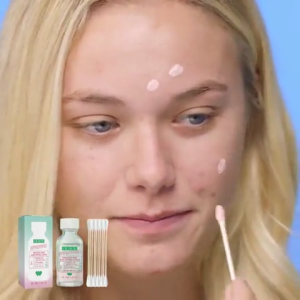 Ouhoe Salicylic Acid Acne Drying Lotion Pimple Salicylic Acid Acne Spot Treatment Care Niacinamide Inflammation & Redness Reliever (30ml+10pcs Cotton Swabs)