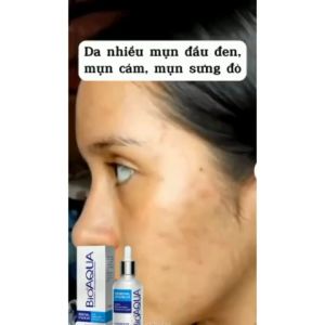 Serum loại bỏ mụn cấp tốc BIOAQUA kháng viêm giảm sưng tấy loại bỏ mụn tận gốc sử dụng cho tất cả các loại mụn giúp giảm mụn & phục hồi da