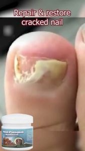 Obat Kuku Berjamur & Rusak: Solusi Terbaik untuk Mengatasi Masalah Kuku