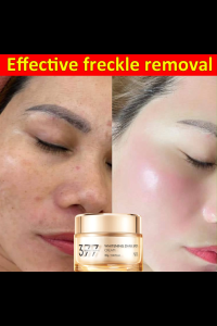 Melasma cream skin whitening and freckle removal effectively removes melasma fades dark spots and freckles removes age spots and moisturizes the skin