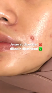 The Originote Acne Spot Cream 10m