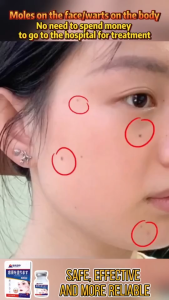 [SG Ready Stock] Japan mole removal cream Quickly remove spots and warts Painless Natural herbal formula No side effects