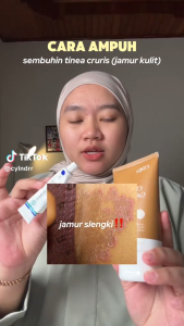 Bundling 3 Pcs Miconazole 2% 10 Gr Paket Hemat Mengatasi Infeksi Jamur Pada Kulit Seperti Kurap Kutu Air Panu