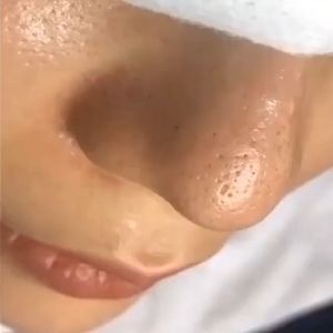 อุปกรณ์กำจัดสิวเสี้ยน - ที่ช่วยการดูแลสุขภาพหัวเสีย รวดเร็ว และยืดหยุ่น สำหรับสิวหัวขาว, สิวหัวดำ, หรือสิวอักเสบ