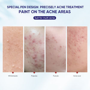 Quarxery Acne Treatment Relieve Redness and Soothing Skin Care Natural Plant Essence Acne Remove (15g)