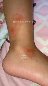 Hegerbaby Soothing Balm – Itch Relief & Mosquito Bite Cream Natural Mint Cooling for Baby 10g