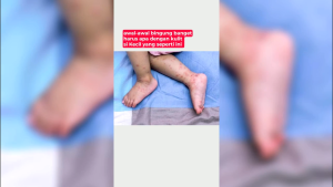 Nubiko Skincare Cream untuk Bayi Anak Dewasa| Untuk Mengatasi Bekas Luka Anak