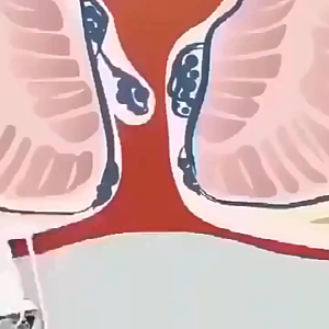 Eelhoe Hemorrhoids Spray Powerful Hemorrhoids Treatment Agent Relieve Pain Painkiller Pain Relief External Fissure 30ml