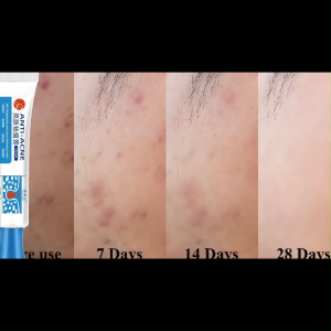 100% Effective Remove Pimples Anti-Acne Treatment Gel Scars Remover Repair Comedone Pimple Quick Acne Removal Cream Acne Repair Cream 25g