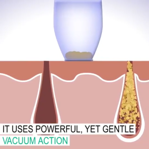 Suction Blackhead Remover Whitehead Remover Electric Facial Extractor with 5 Probes USB Rechargeable Vacuum Pore Cleaner