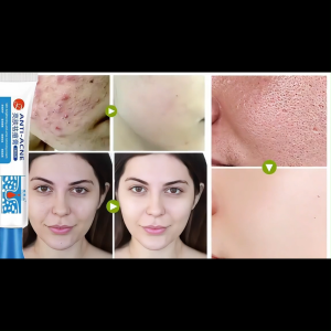 100% Effective Scar Removal Cream 25g Acne Scar Remover Anti Acne Repair Strech Marks Pimple Marks Acne Treatment Skin Care Remover Acne Cream Acne Treatment Gel Skin Care Repair Pits Facial Scar Care Ointment Pimple Marks And Dark Spots Remover