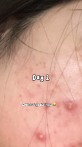 Ms Glow Serum Acne Ori Asli / Acne Serum Ms Glow Original Bpom / Serum Penghilang Jerawat